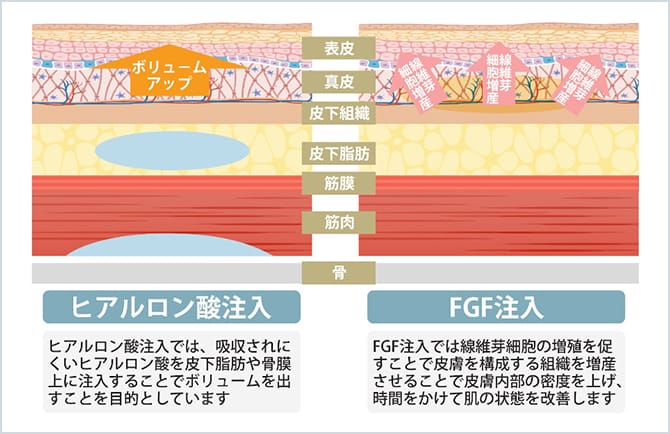 ヒアルロン酸注入とFGF注入の違いの図