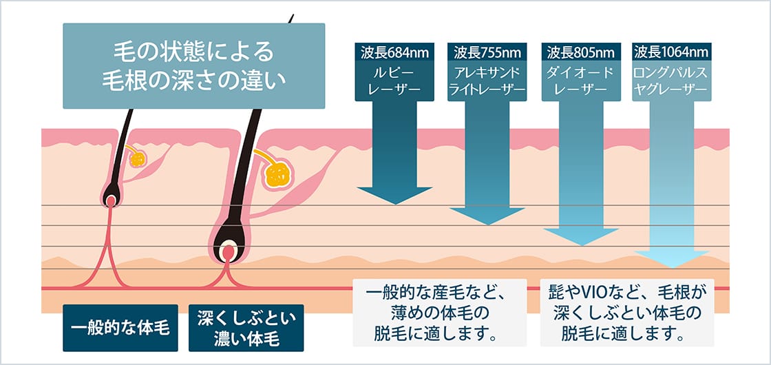 毛の状態による毛根の深さの違い