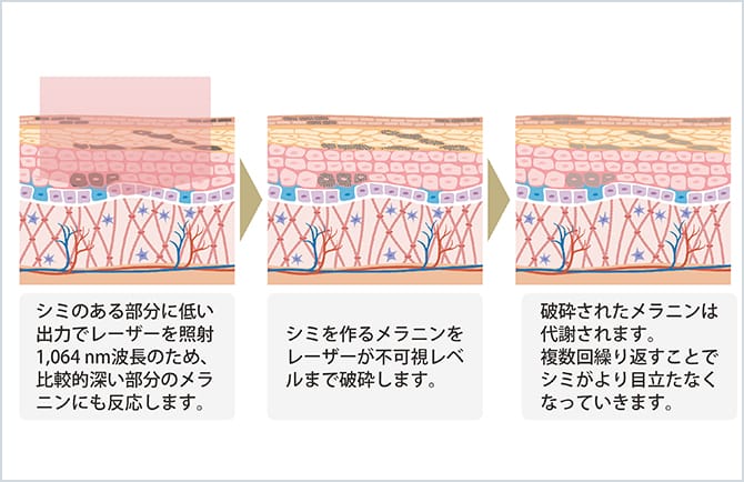 レーザーシミ取りによるシミの変化図