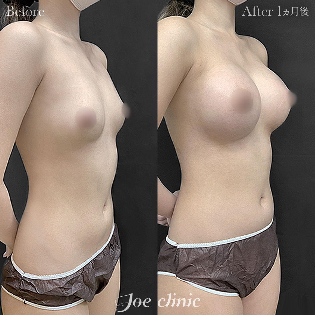 【20代女性】シリコンバッグ豊胸モティバ2（325cc×左右）｜1ヵ月後